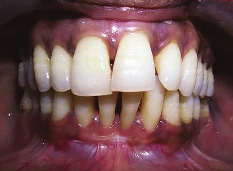 partial thickness flap was raised apical to the initial incision extending at least one tooth on either side of defect region (Fig. 1).