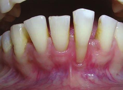 No clinical changes were observed in the gingival recession and pocket depth at baseline and 6 months follow-up.