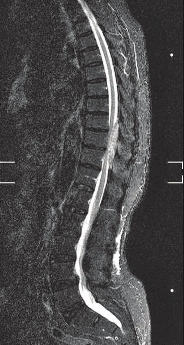 After contrast administration, the lesion showed heterogeneous enhancement (C) A 63-year-old female presented with low back pain for half a year, and worsening of radiating pain with corresponding