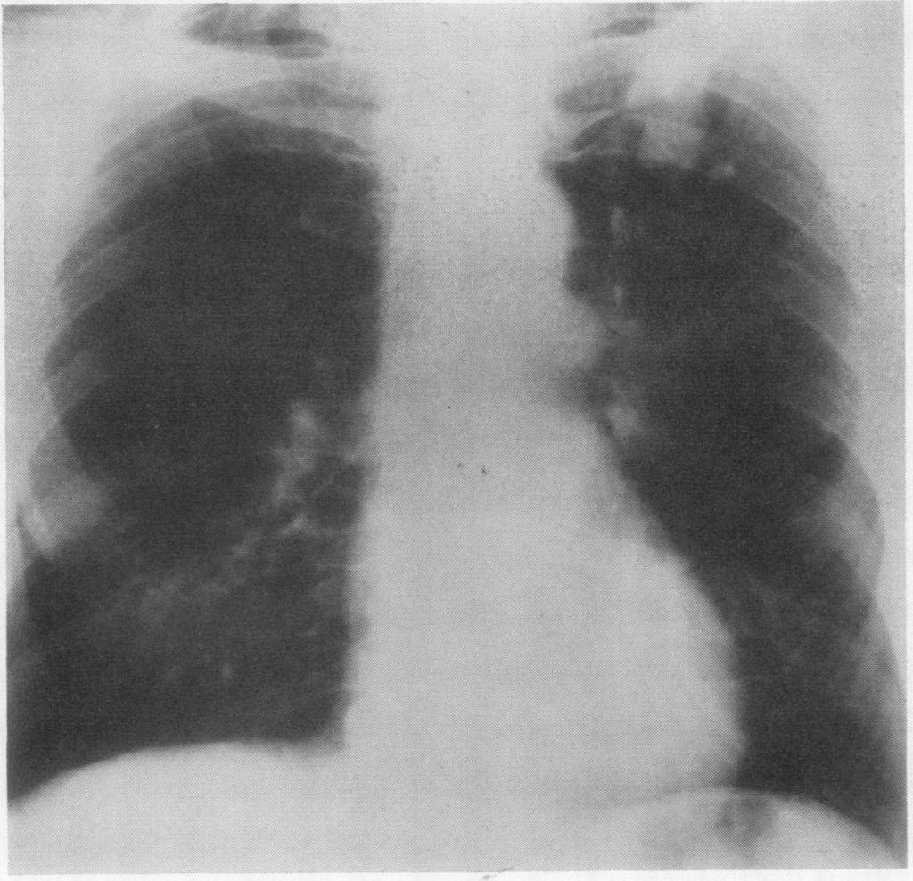 Thorax,(1970), 25, 366. Primary chondrosarcoma of lung G. M. REES Department of Surgery, Brompton Hospital, Lontdonl, S.W.