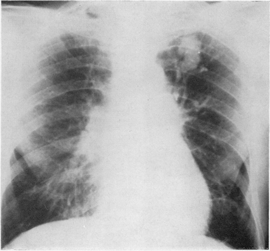 Primary chondrosarcoma of lung FIG. 2. 367 Thorax: first published as 10.