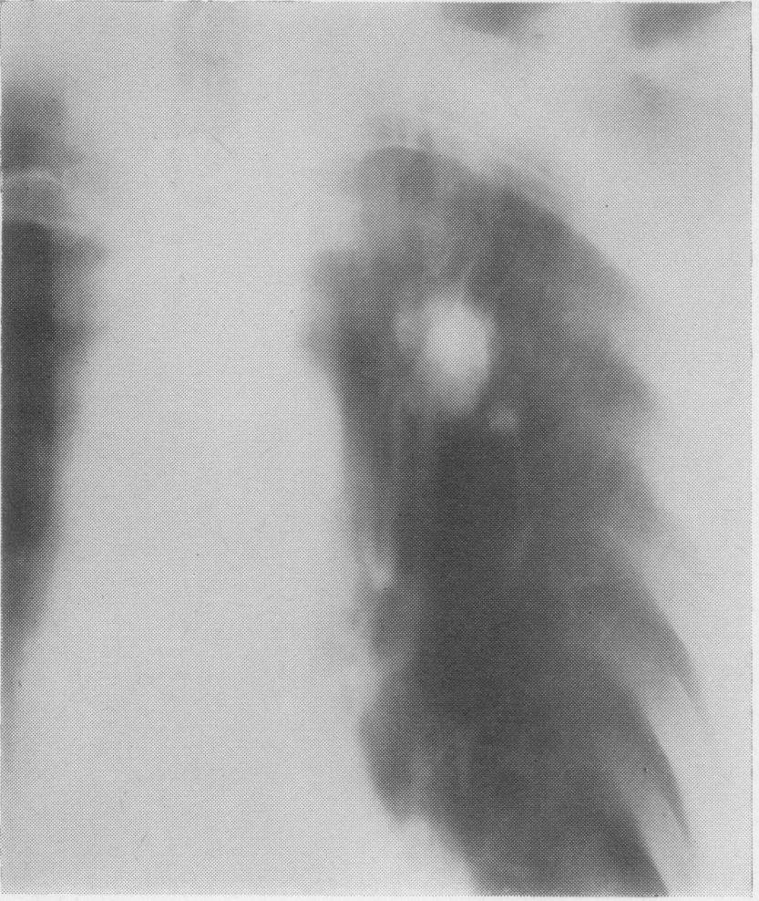 368 of the world literature. A further case is described here which was treated surgically at the Brompton Hospital. FIG. 4. FIG. 5. FIGS 4 and 5. 19 August 1965. Tomographs of left upper lobe.