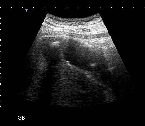 Gallbladder GS can migrate to the fundus, particularly if fold