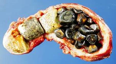Gallstones 10-15% of people in the adult Western world develop