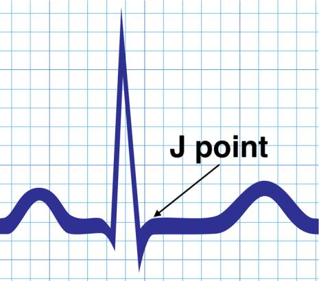 STEMI Definition STEMIs are characterized by the presence of both criteria: ECG evidence of STEMI: ST-segment elevation at the