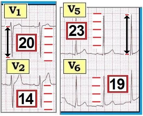 Left Ventricular Hypertrophy (LVH)» Increases height of QRS» Voltage criteria formula for determining if LVH: 1.