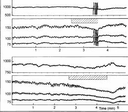 Antiarrhythmic Effect of Repeated Coronary Occlusion During Balloon Angioplasty RR interval (ms) Blood pressure (mmhg) Ventricular ectopy First occlusion RR interval (ms) Blood pressure (mmhg) No