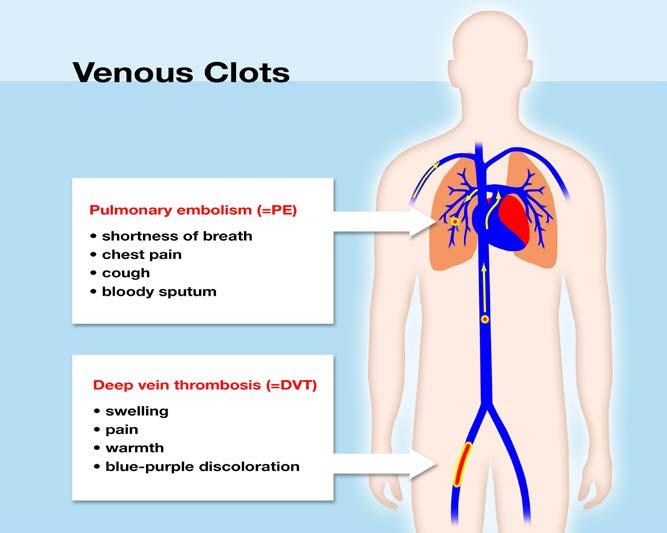 Meta-analysis of prediction models for diagnosing deep vein thrombosis Diagnosis of deep vein thrombosis (DVT) Blood clot that forms in a vein in the body