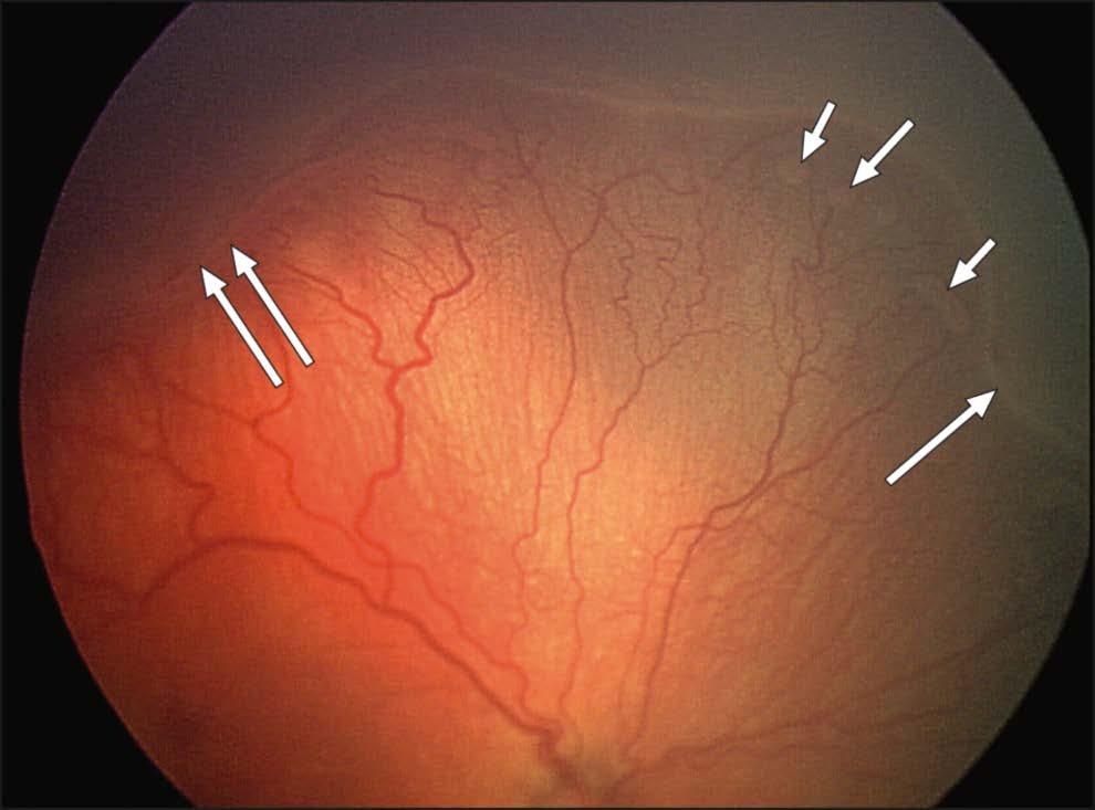 Classification- Severity Stage 2: an elevated ridge (long arrows) separating vascularized and nonvascularized retina.