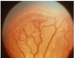 Classification- Severity Stage 3: a ridge with extraretinal fibrovascular