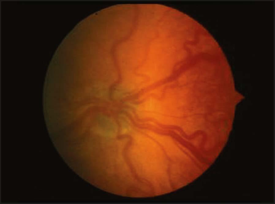 Plus Disease Dilation and tortuosity of the retinal vasculature in at least 2 quadrants Signifies actively progressive