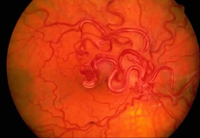 Wyburn-Mason Syndrome Arteriovenous malformations of the retina, optic nerve, brain, facial structures