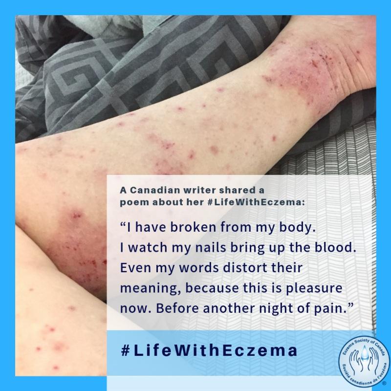 #LifewithEczema: in their own words Share your images and stories to help us show why #eczemamatters To shed light on the reality of #LifewithEczema, ESC invited our community to submit pictures and
