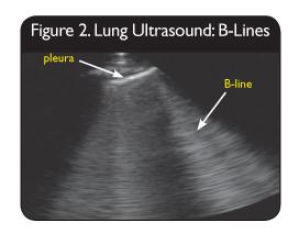 Lung Ultrasound for B- Lines (Lung
