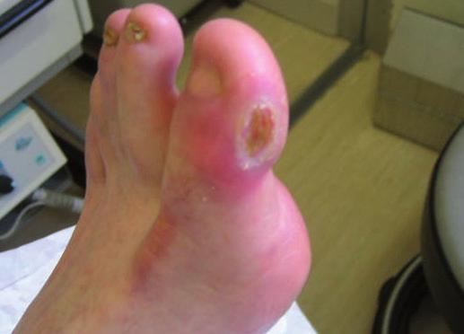 The changes usually happen in both feet at the same time and can progress from your toes to your feet and sometimes the legs, fingers and hands can be affected, although this is less common.