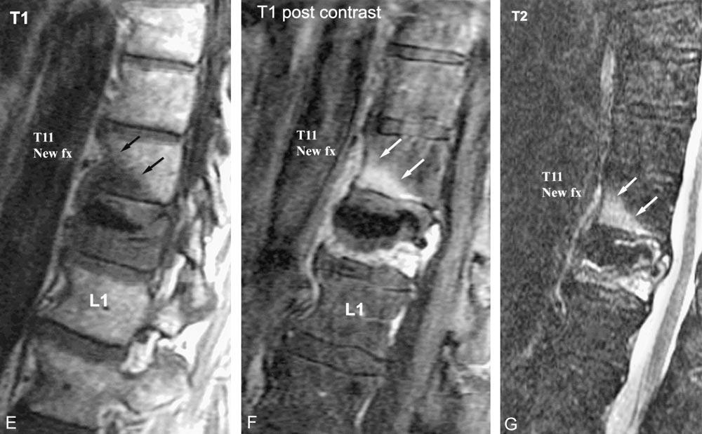 178 LIN AJNR: 25, February 2004 FIG. 1. Continued E, Sagittal view T1-weighted MR image obtained 15 days later, when the patient returned with new pain, shows new bone marrow edema of T11.