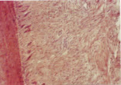 Mukoperiostalni LPR ra en u kombinaciji sa limunskom kiselinom pripoj i orijentacija kolagenih vlakana gingive za cement