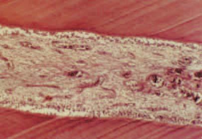 Serbian Dental J, 2007, 54 219 U subepitelnom tkivu su prisutna sitna žarista inflamacije u iji sastav ulaze monojedarne elije, limfociti i plazmociti.