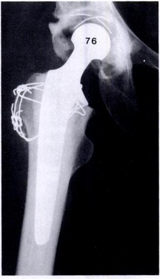 The original diagnoses ofthe 50 hips were congenital dislocation and/or dysplasia (19), pistol-grip