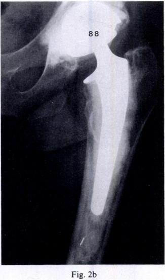 (4), avascular Figure la - A postoperative radiograph shows excellent cement distribution ( white-out )