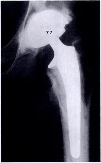Figure 2a - A postoperative radiograph shows slight radiolucencies at the cementbone interface, graded B.