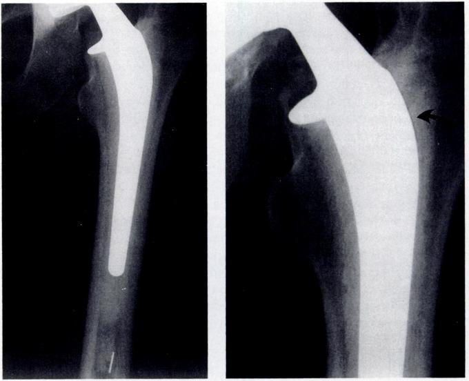 IMPROVED CEMENTING AND FEMORAL LOOSENING IN YOUNG PATIENTS WITH HIP ARTHROPLASTY 387 tions were for revision of failed cemented components, two for failed femoral osteotomies, one for a failed cup