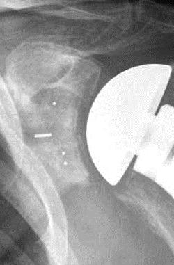 Inserted Glenoid Component with Three