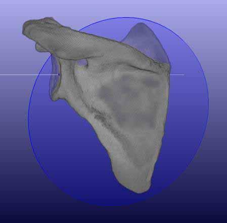 Advanced 3D clinical CT imaging allows defining an anatomic coordinate system An anatomic, scapular