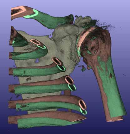 Advanced 3D clinical CT imaging allows super-imposition of multiple 3-D CT volumes Multiple 3D CT volumes (immediate post-operative and follow-up)