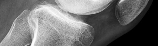 surface of lateral femoral