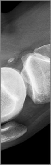 Patellar Height: Caton-Deschamps Index Applicable to lateral film, ideally