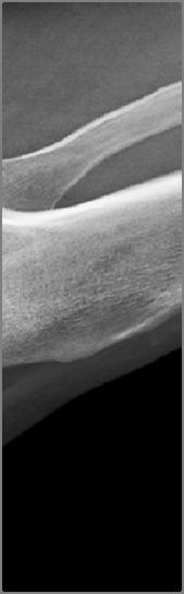 blue line) Measure the distance between the inferior edge of the patellar