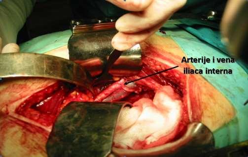 Donja medijana laparotomija U većini slučajeva učini se zdjelična limfadenektomija što podrazumijeva odstranjenje limfnih čvorova oko vene i arterije ilijake interne,
