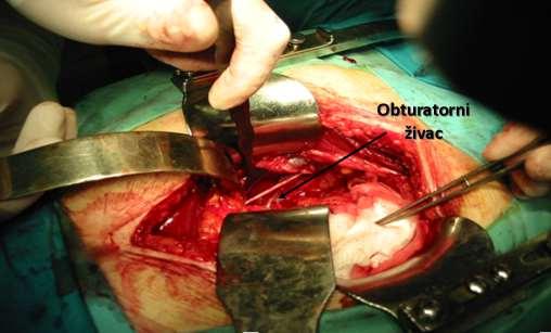Slika 11: Obturatorna limfadenektomija Prilikom operativnog odstranjenja prostate