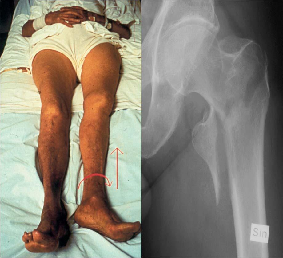 The Hip Fracture Patient Woman Age 82 years Frail Low body weight Multiple