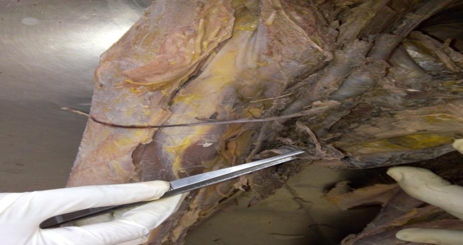 OBSERVATION During the routine dissection the variation of *GSV was observed unilaterally in the right thigh region of the male cadaver.