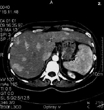 Scintigraphically a clear reduction of the primary tumor and the liver metastases can be seen.