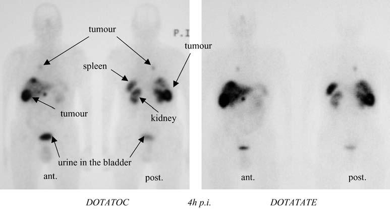 60 CHAPTER 3 Fig. 3. Whole-body scans of patient no. 2, 4 h after injection of 222 MBq 111 In-DOTATOC (left) and 111 In-DOTATATE (right).