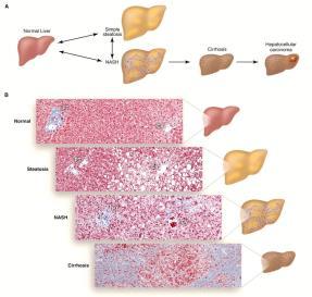 NAFLD, NASH, and alcoholic liver disease Jonathan Congeni MD NAFLD, NASH, and alcoholic liver disease Disease overview Epidemiology Pathogenesis Clinical features Labs and imaging Evaluation options