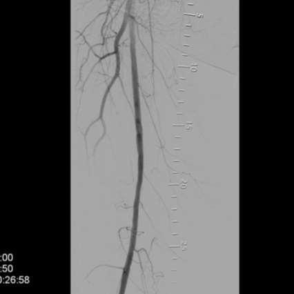 (or prior, in the case of any TLR) by core lab quantitative vascular angiography TVA BASELINE Area: 1073.
