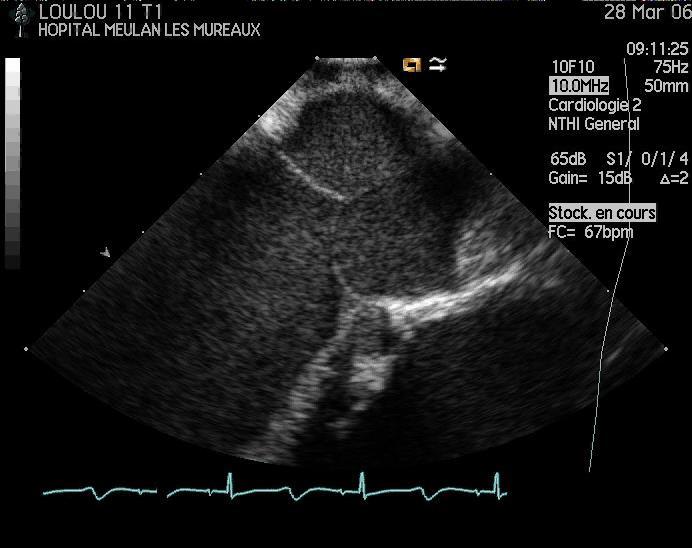 Aortic valve opening starts prior to ejection (2.1±0.