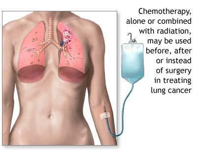 4 major types of treatment for cancer are
