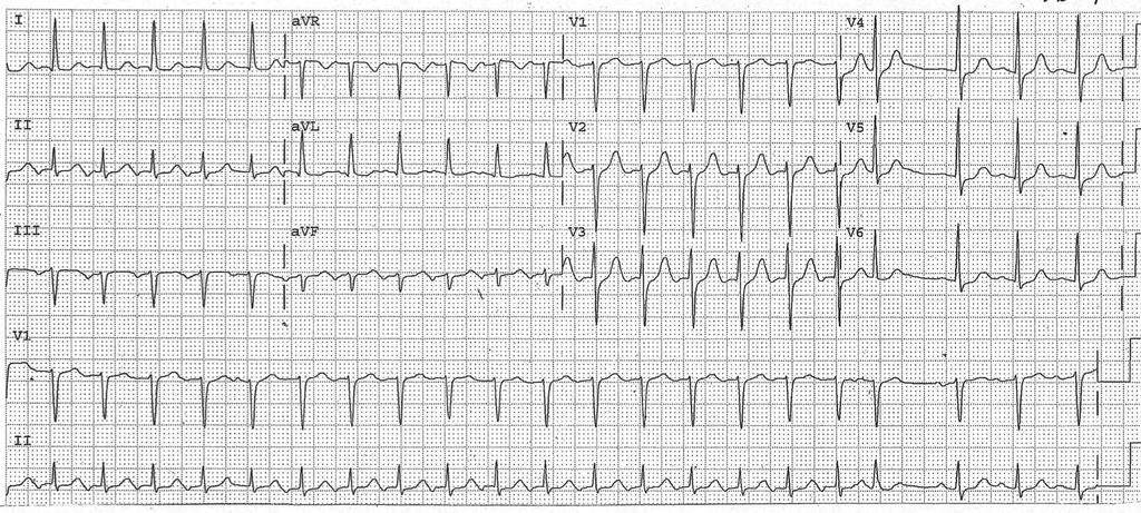 81 Year old woman. Tracing 5: Answer Your choice: 1. 2. 3. 4. Typical A.V.N.R.T.? Atypical A.V.N.R.T.? Primary atrial tachycardia? A.V.R.T.? It is evident that the inverted P wave in front of the QRS complexes is responsible for this subventricular tachycardia.
