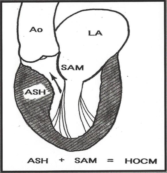 Asymmetrical hypertrophy of the ventricular septum, plus systolic