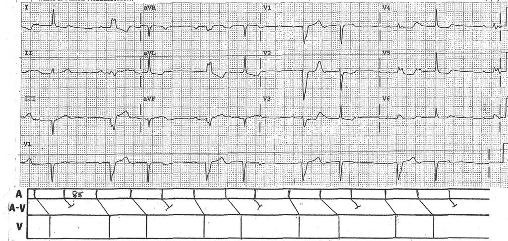 88 Year old woman. Tracing 1: Answer What is phase 4 abberation? 85 There is sinus rhythm at 85/min. which is conducted with 3:2 Wenckebach A-V block.