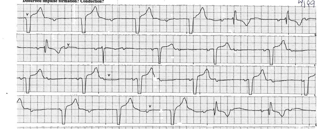 Tracing 3: Answer 65 Year old man. Holter recording Disturbed impulse formation? Conduction? C C F F 75 F F 35 F C This man was markedly symptomatic with dizziness and near syncope.