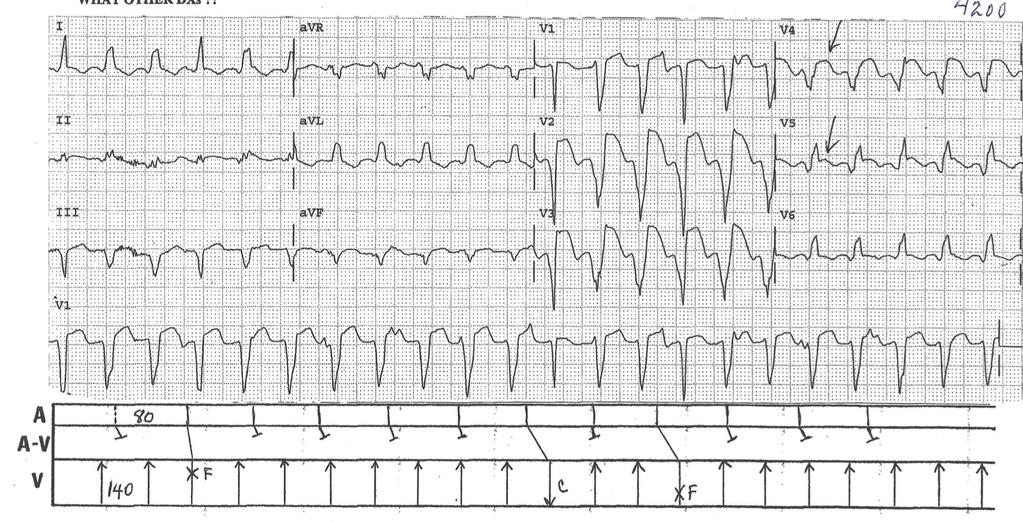 87 Year old man. A nifty example of V.T.!! Tracing 4: Answer What features indicate this?? What other DXs?