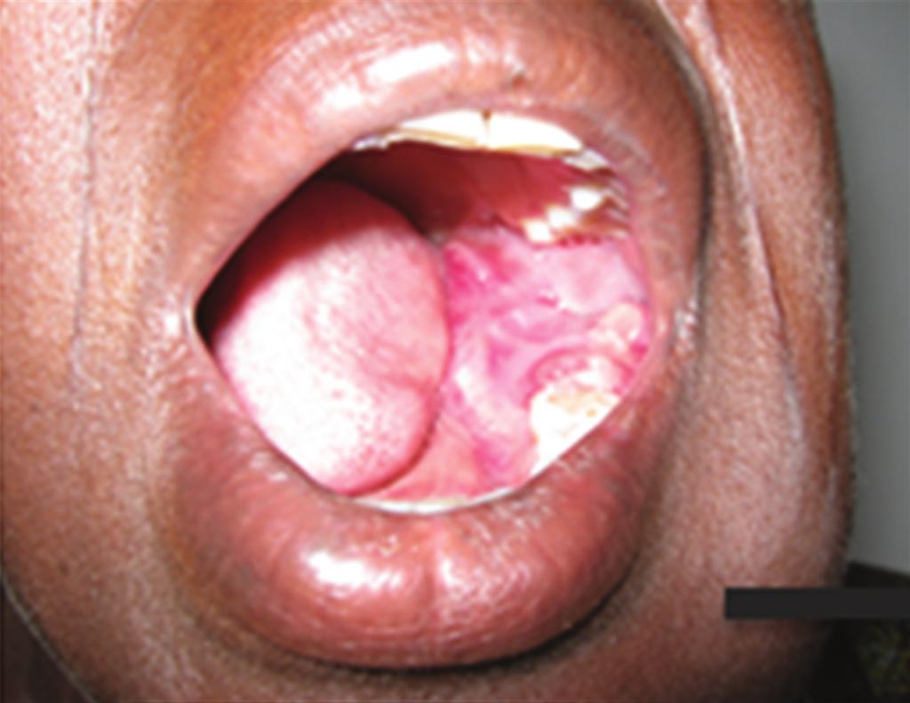 presence of an irregular, shapeless mass of radiopacity can be seen white arrow. well as the surgical excision of the fibroosseous lesion on the right.