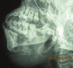 An incisional biopsy of the right mandibular lesion revealed chondroblastic osteogenic sarcoma (Figure 3(d)).