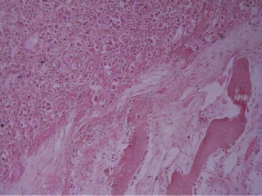(d) Chondroblastic osteosarcoma of case 2 showing a malignant mesenchymal neoplasm consisting of pleomorphic chondroblast with prominent hyperchromatic nuclei amidst malignant osteoid(x100).
